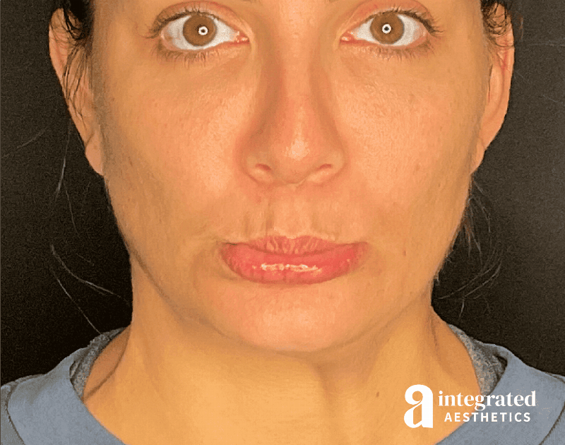 Wrinkle Relaxers Before & After Gallery - Patient 284499 - Image 4