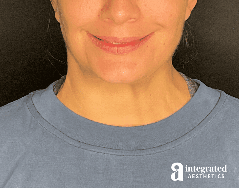 Wrinkle Relaxers Before & After Gallery - Patient 284499 - Image 6