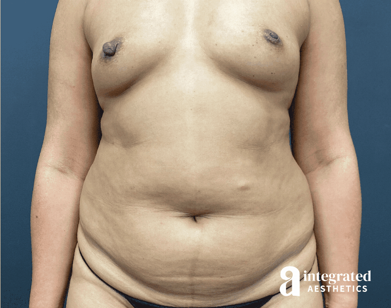 Tummy Tuck Before & After Gallery - Patient 341500 - Image 1