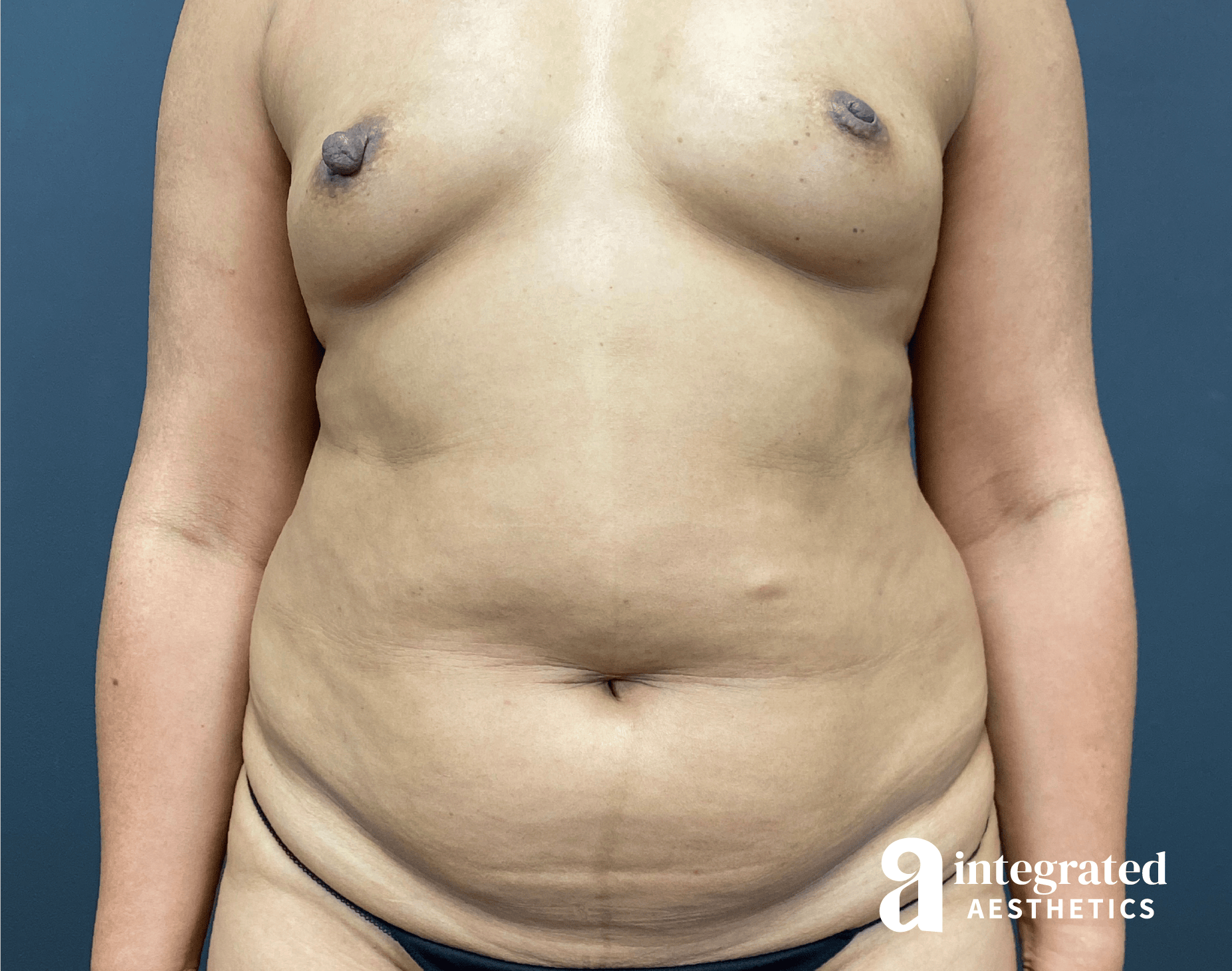 Tummy Tuck Before & After Gallery - Patient 341500 - Image 1