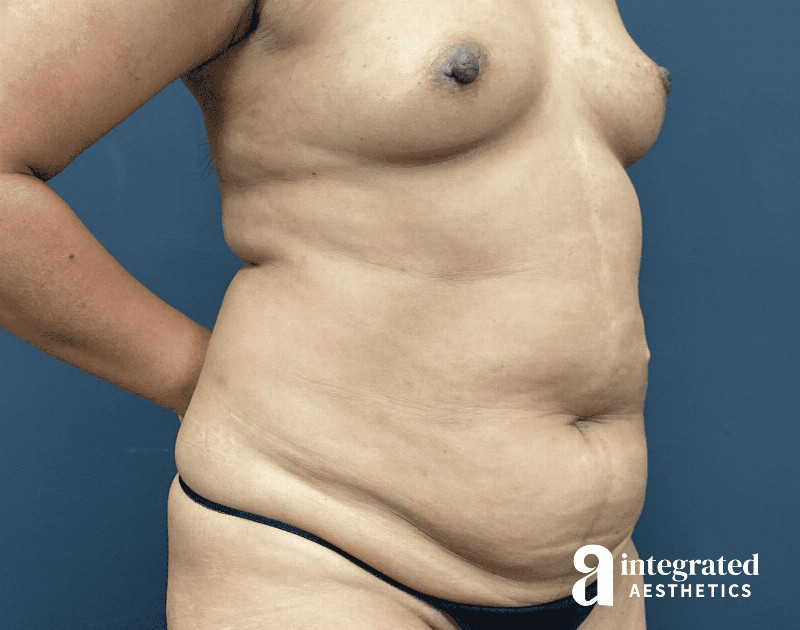 Tummy Tuck Before & After Gallery - Patient 341500 - Image 3