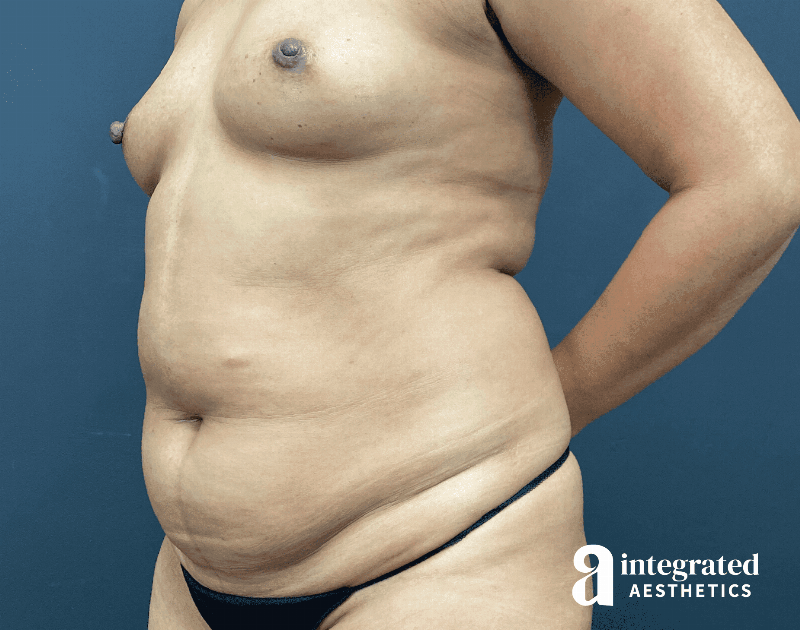 Tummy Tuck Before & After Gallery - Patient 341500 - Image 5