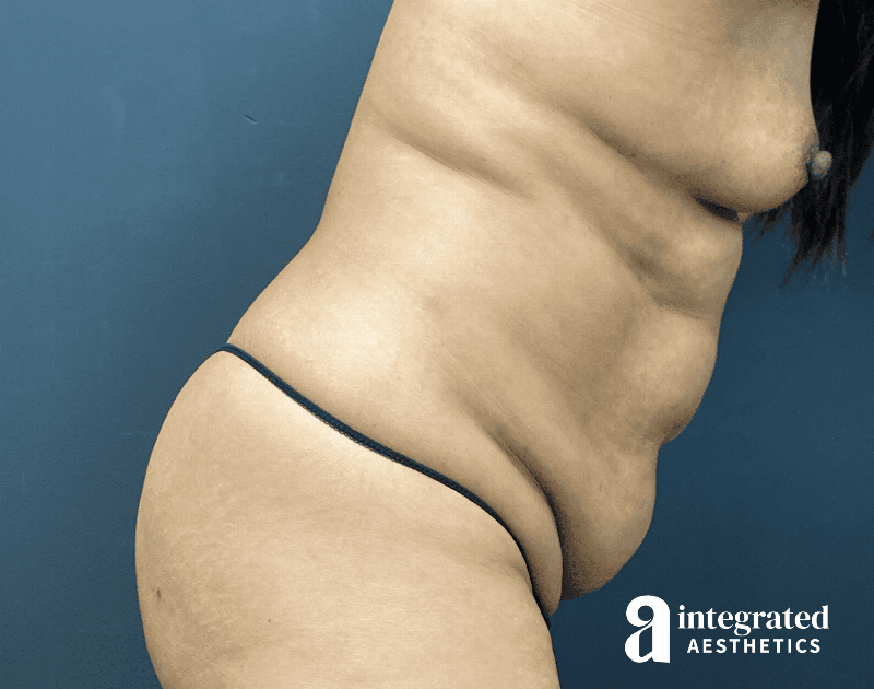 Tummy Tuck Before & After Gallery - Patient 341500 - Image 9