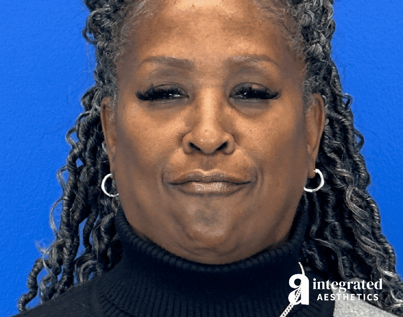 Wrinkle Relaxers Before & After Gallery - Patient 224804 - Image 6