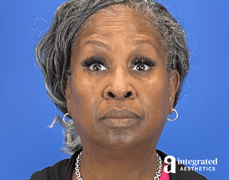 Wrinkle Relaxers Before & After Gallery - Patient 224804 - Image 3