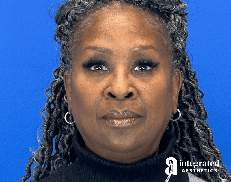 Wrinkle Relaxers Before & After Gallery - Patient 224804 - Image 4