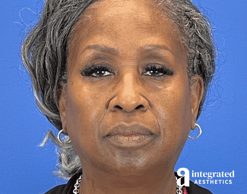 Wrinkle Relaxers Before & After Gallery - Patient 224804 - Image 1