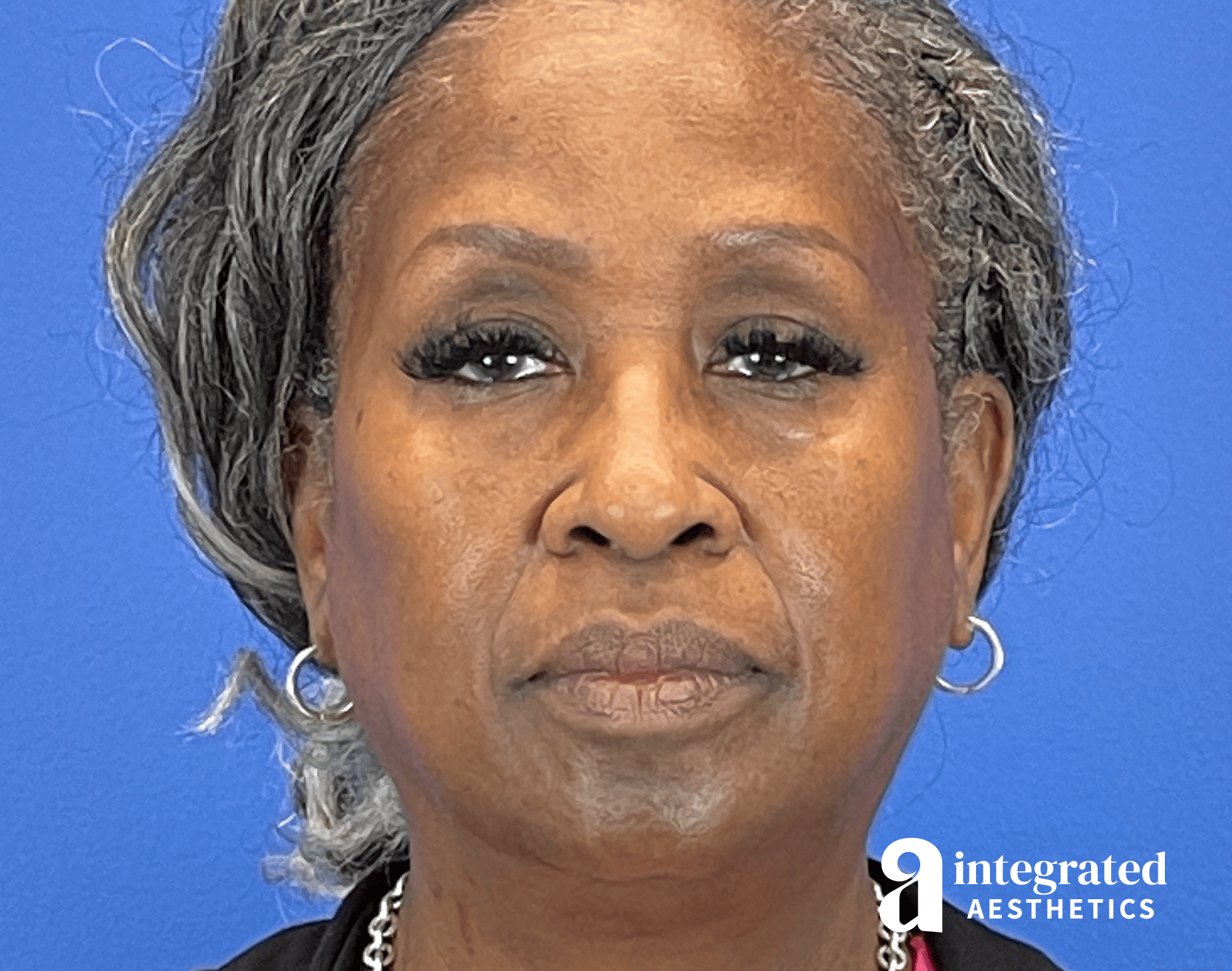 Wrinkle Relaxers Before & After Gallery - Patient 224804 - Image 1