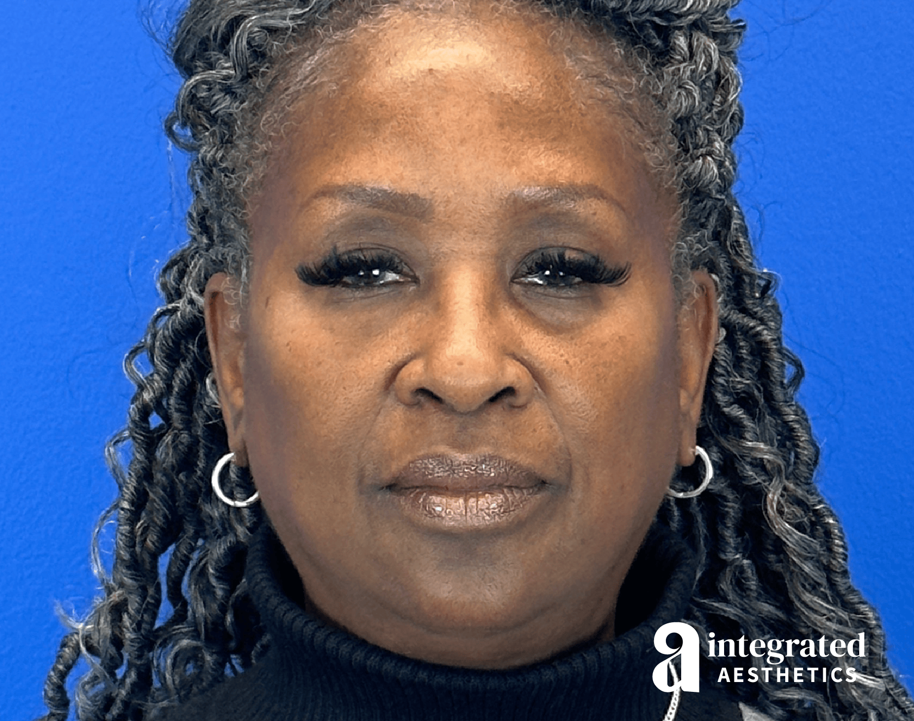 Wrinkle Relaxers Before & After Gallery - Patient 224804 - Image 2