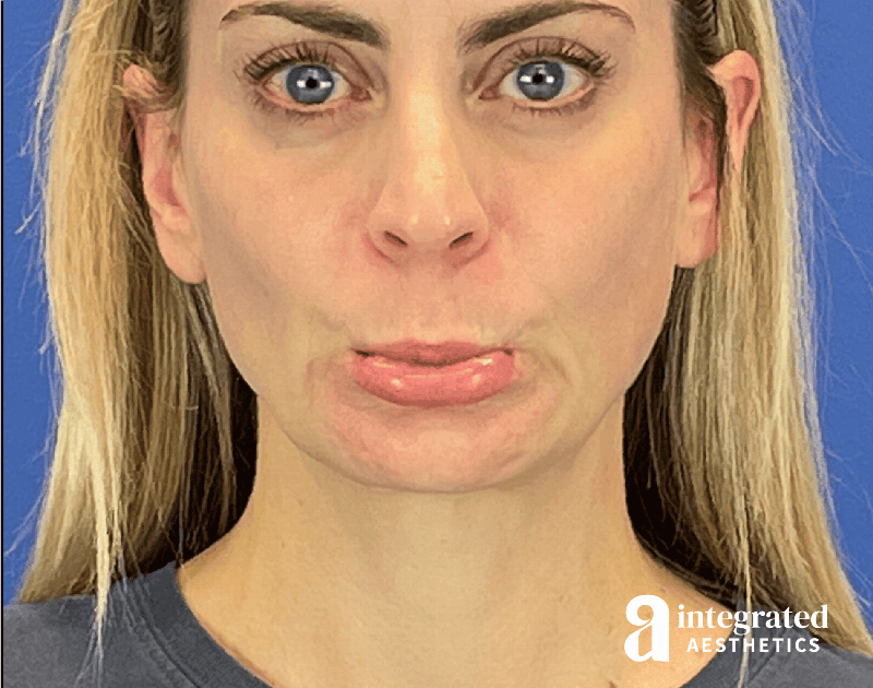 Wrinkle Relaxers Before & After Gallery - Patient 332046 - Image 3