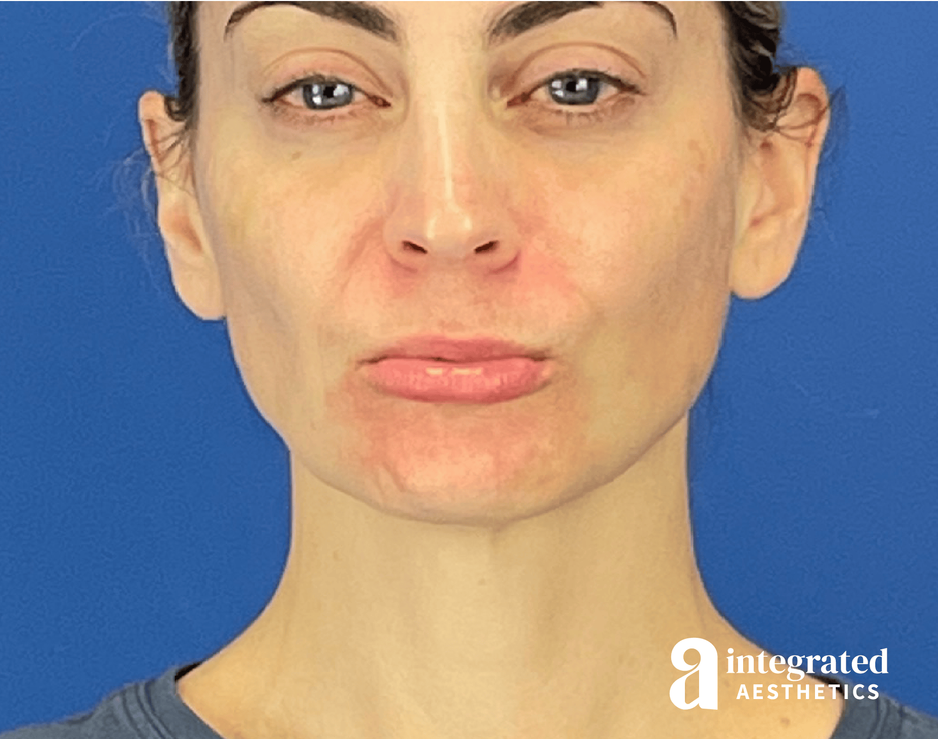 Wrinkle Relaxers Before & After Gallery - Patient 332046 - Image 4