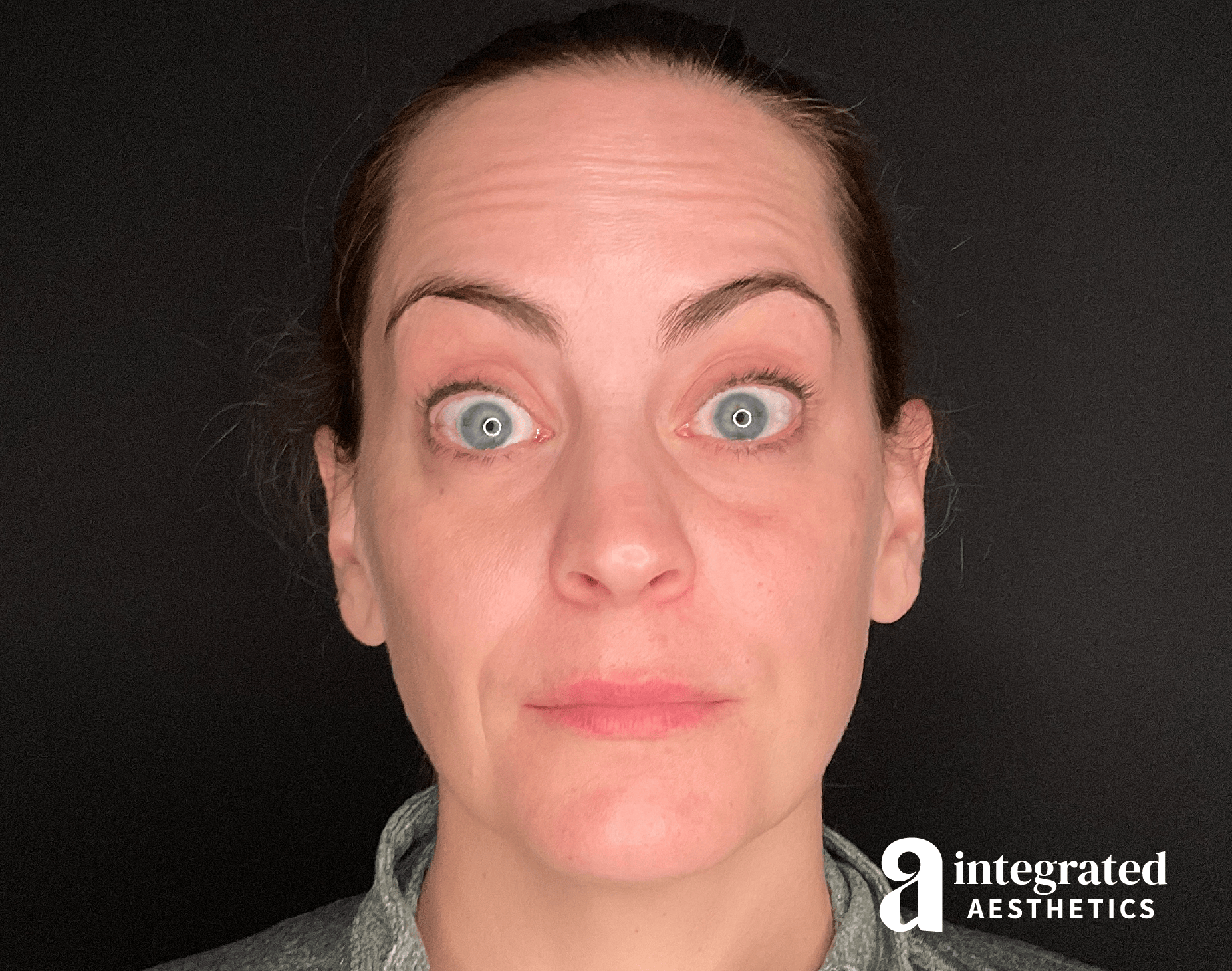 Wrinkle Relaxers Before & After Gallery - Patient 175577 - Image 1