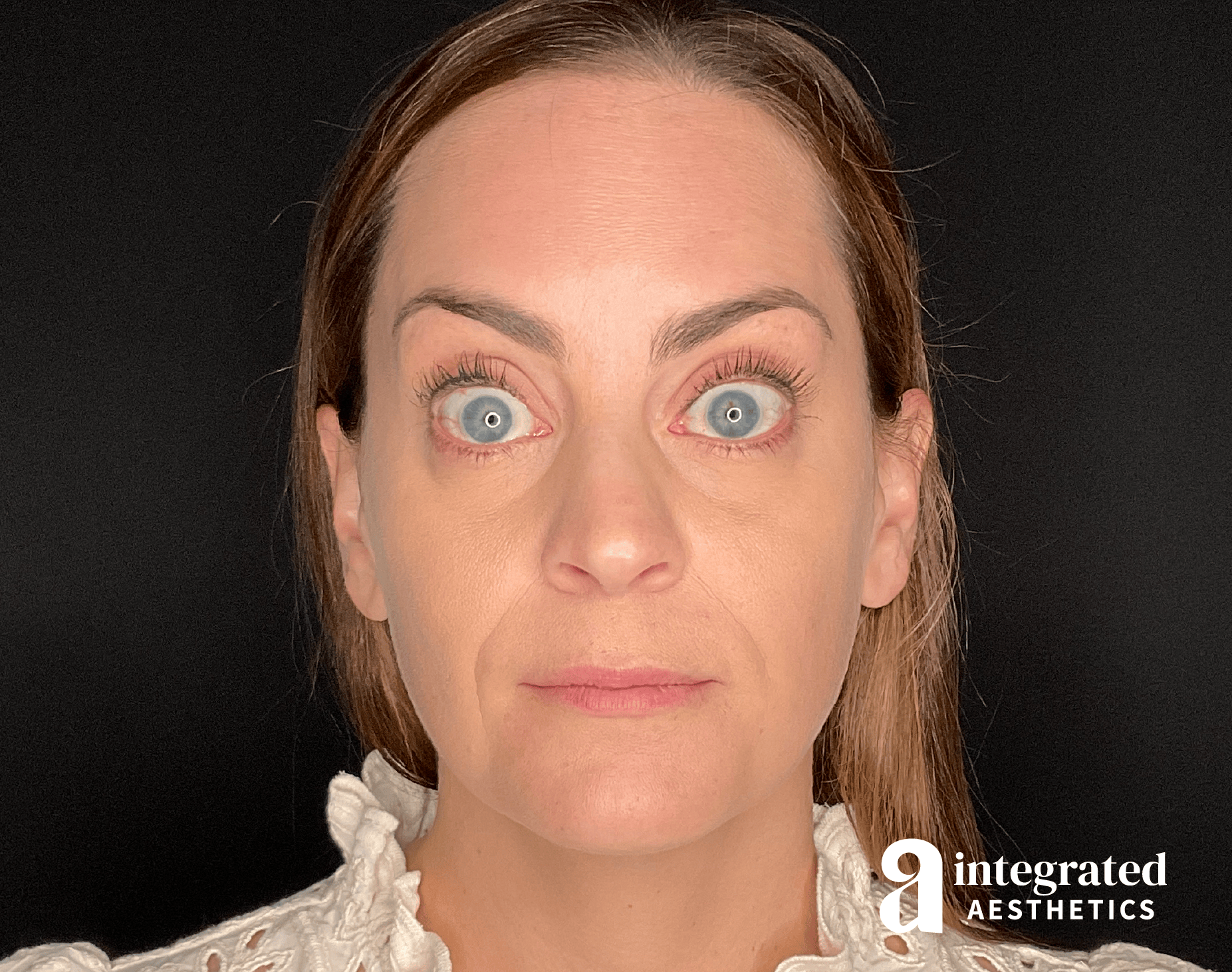 Wrinkle Relaxers Before & After Gallery - Patient 175577 - Image 2