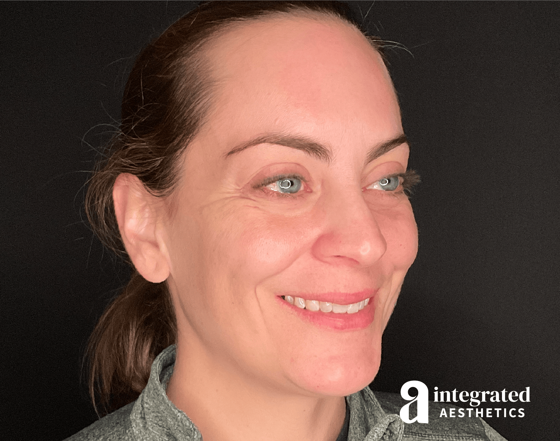 Wrinkle Relaxers Before & After Gallery - Patient 175577 - Image 3