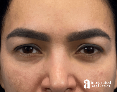 Brow Lift Before & After Gallery - Patient 260757 - Image 1