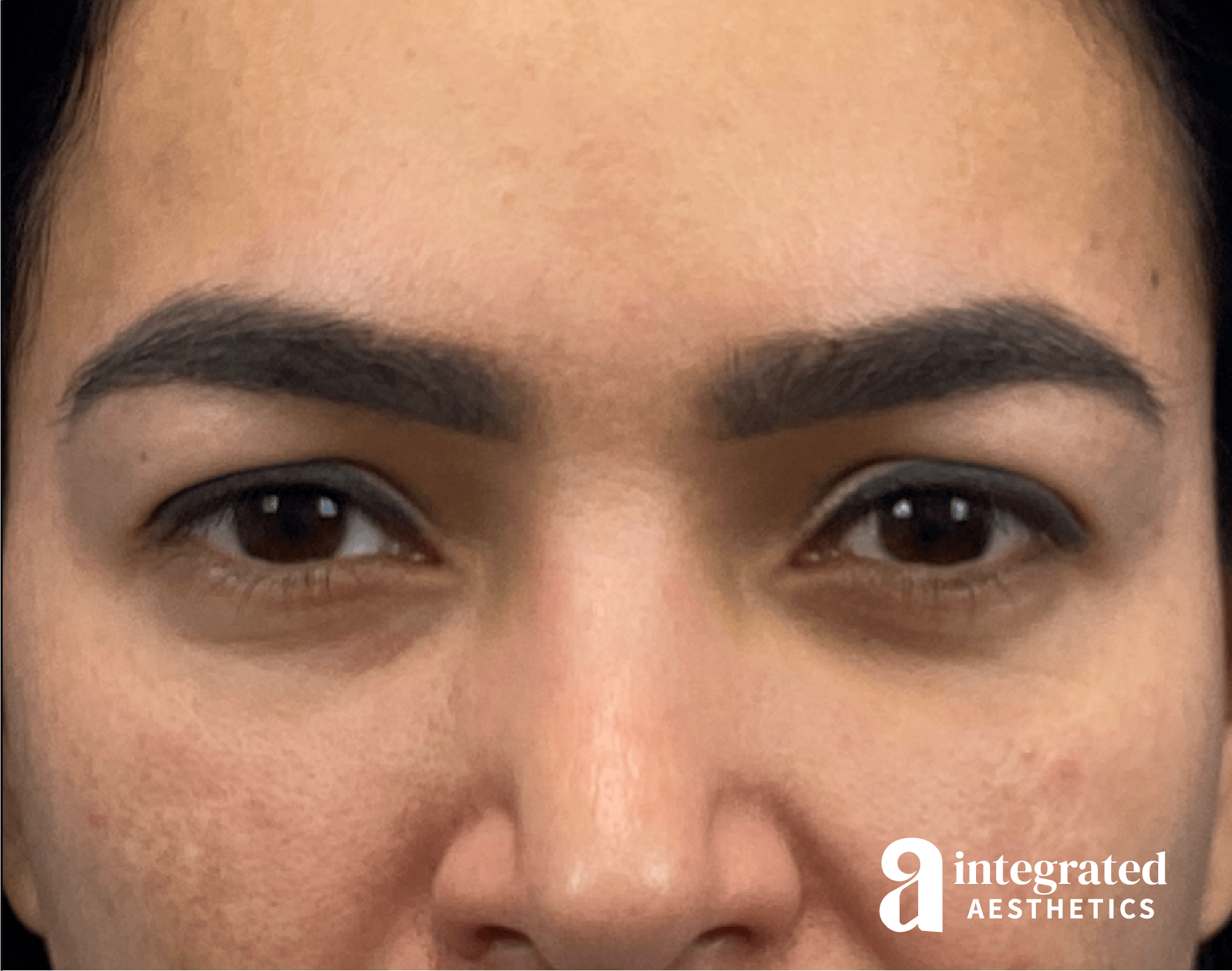 Blepharoplasty Before & After Gallery - Patient 375146 - Image 1