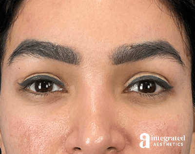 Brow Lift Before & After Gallery - Patient 260757 - Image 2