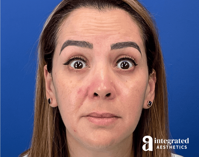 Wrinkle Relaxers Before & After Gallery - Patient 300086 - Image 1