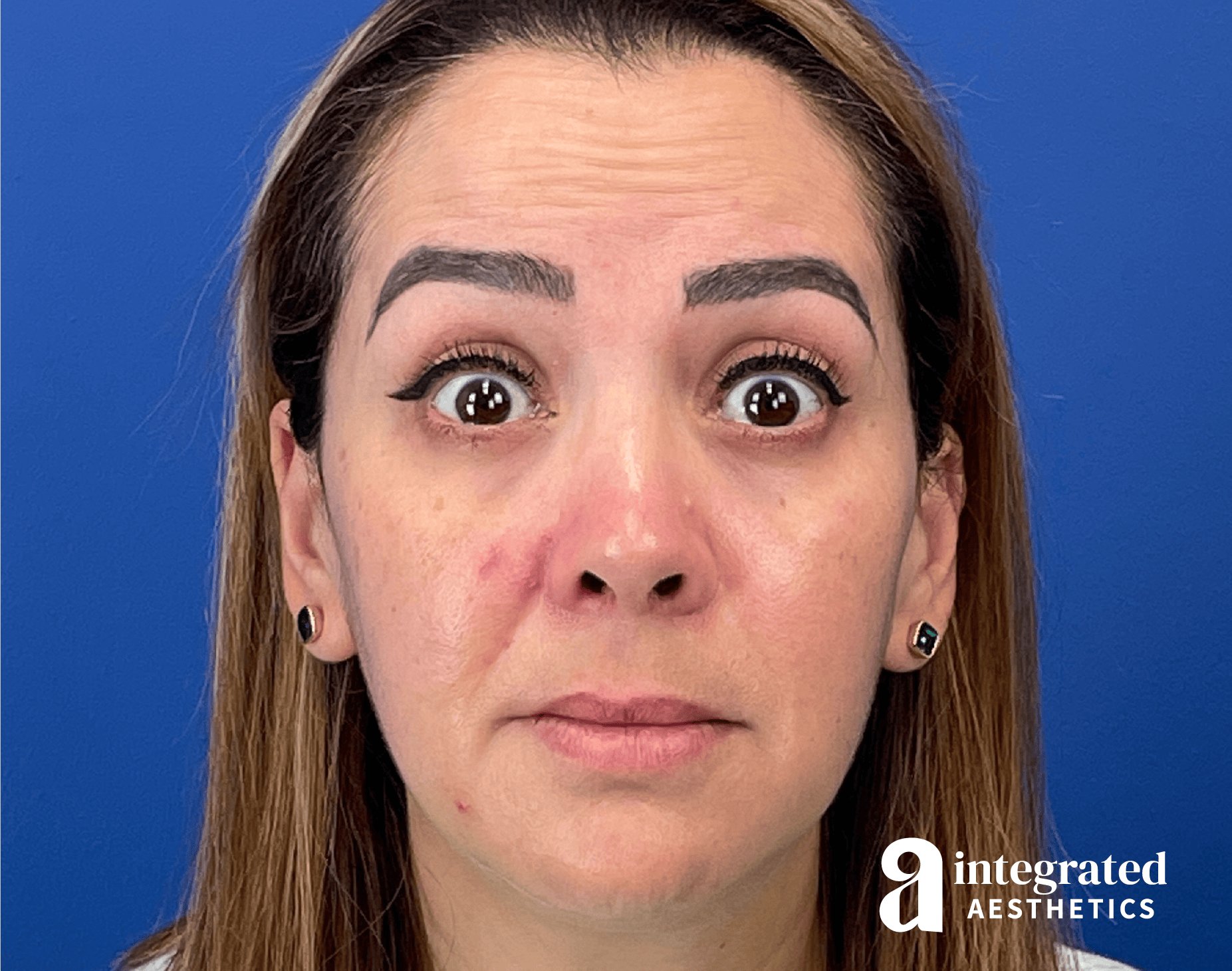 Wrinkle Relaxers Before & After Gallery - Patient 300086 - Image 1