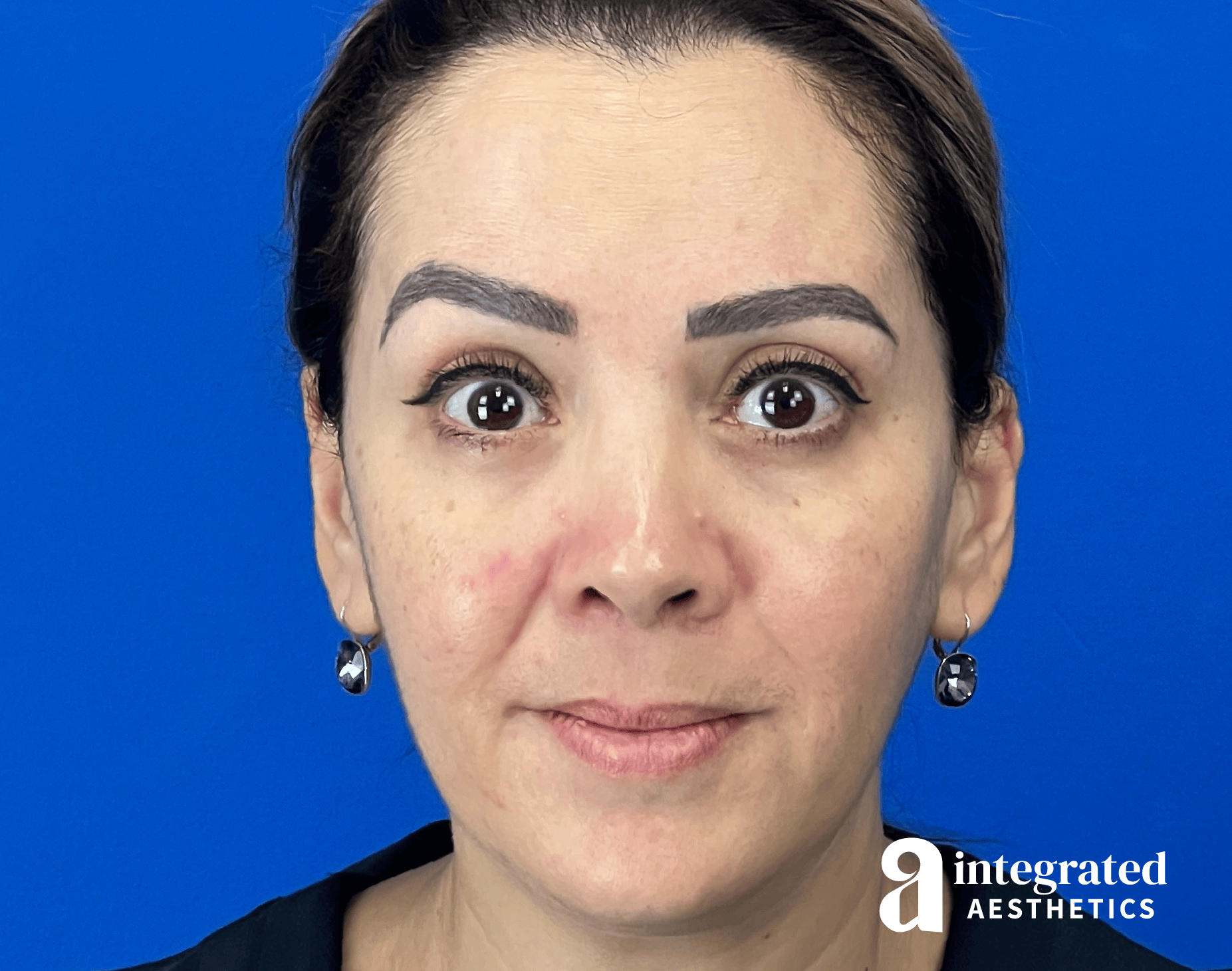 Wrinkle Relaxers Before & After Gallery - Patient 300086 - Image 2