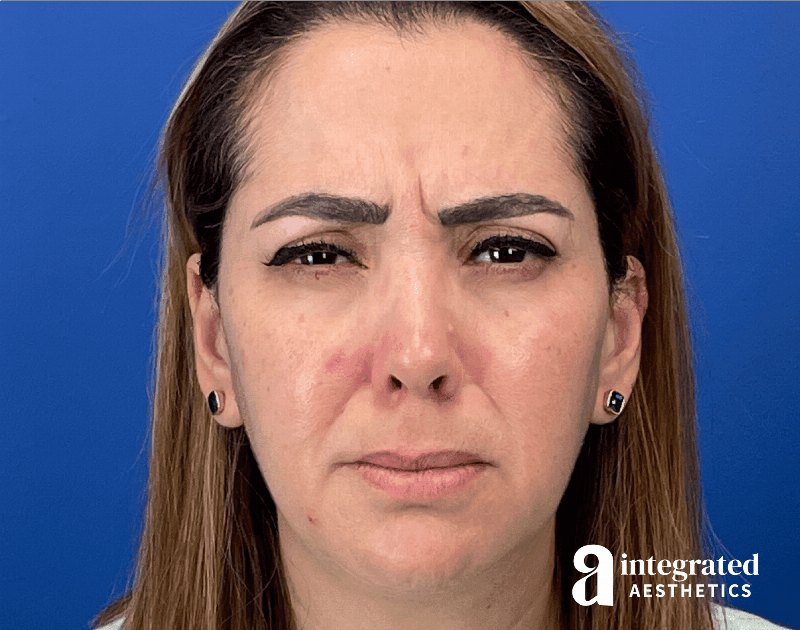 Wrinkle Relaxers Before & After Gallery - Patient 300086 - Image 3