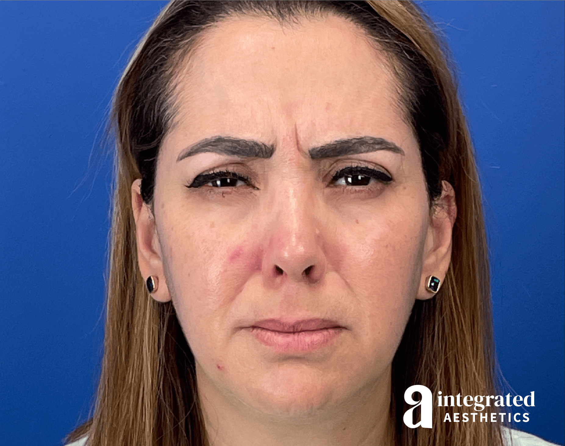 Wrinkle Relaxers Before & After Gallery - Patient 300086 - Image 3