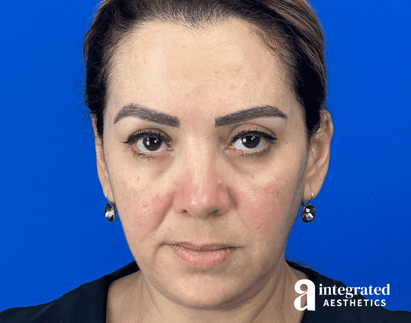 Wrinkle Relaxers Before & After Gallery - Patient 300086 - Image 4