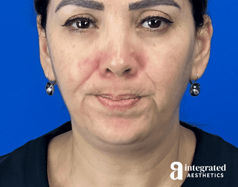 Wrinkle Relaxers Before & After Gallery - Patient 300086 - Image 6