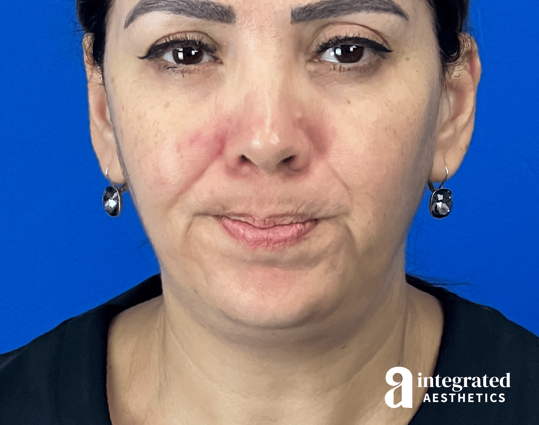 Wrinkle Relaxers Before & After Gallery - Patient 300086 - Image 6