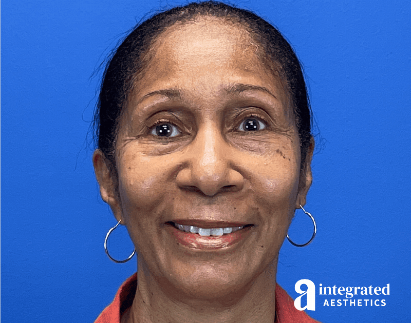 Sculptra Before & After Gallery - Patient 412807 - Image 1