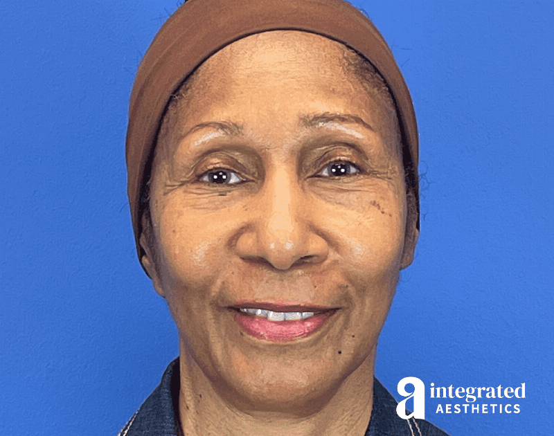 Sculptra Before & After Gallery - Patient 412807 - Image 2