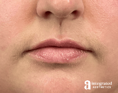 Lip Filler Before & After Gallery - Patient 238479 - Image 1