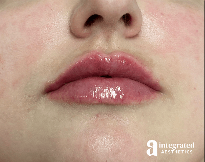 Lip Filler Before & After Gallery - Patient 238479 - Image 2