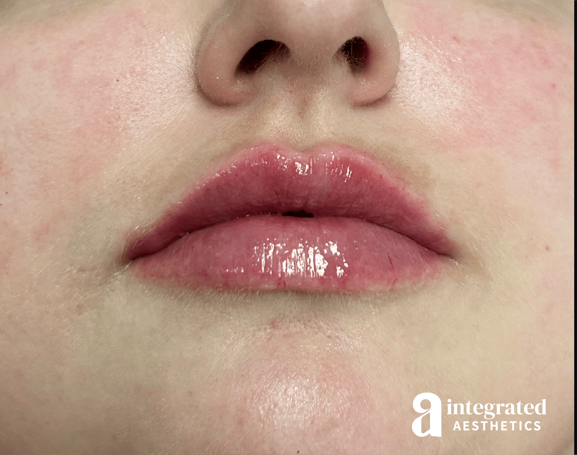 Lip Filler Before & After Gallery - Patient 238479 - Image 2