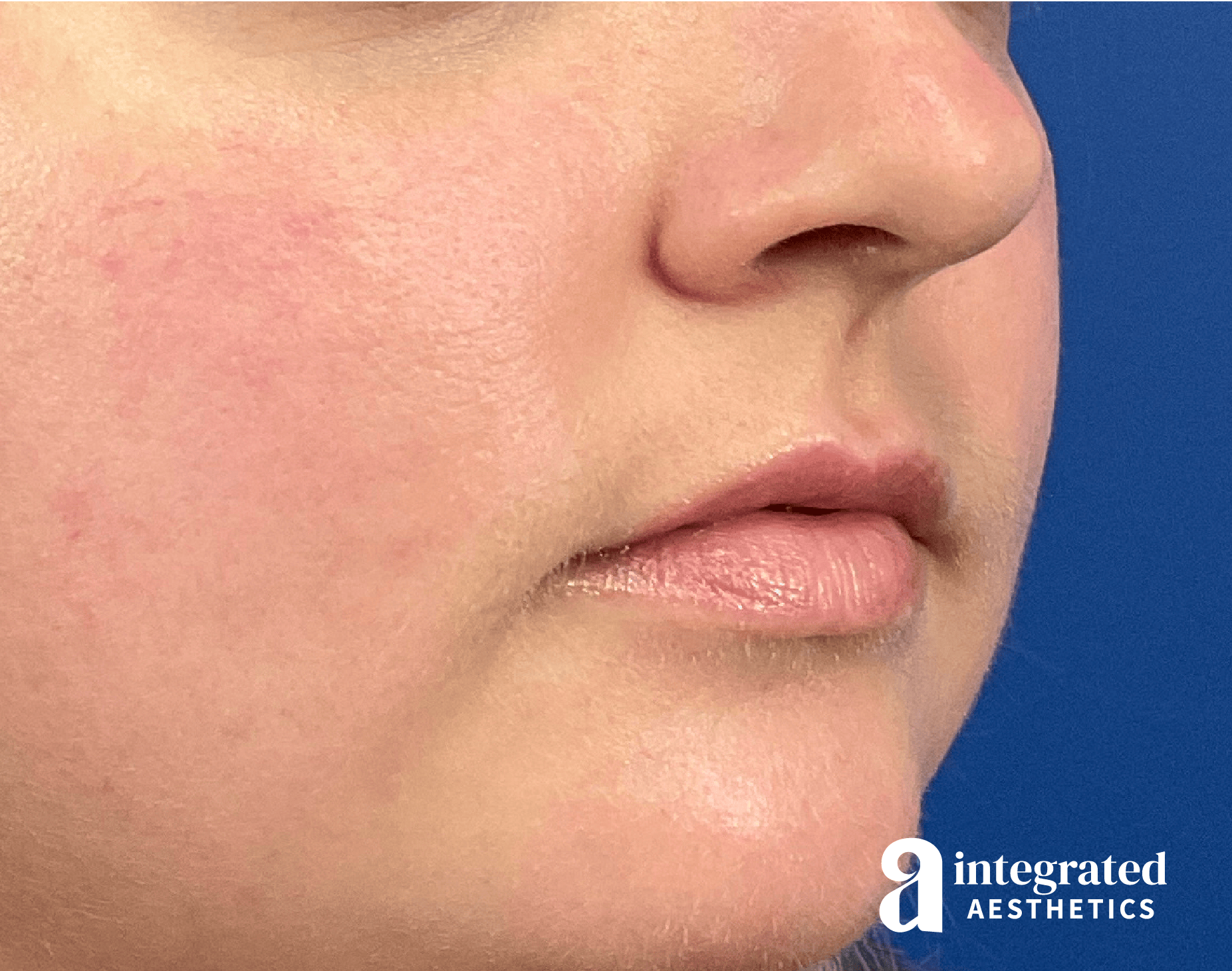 Lip Filler Before & After Gallery - Patient 238479 - Image 3