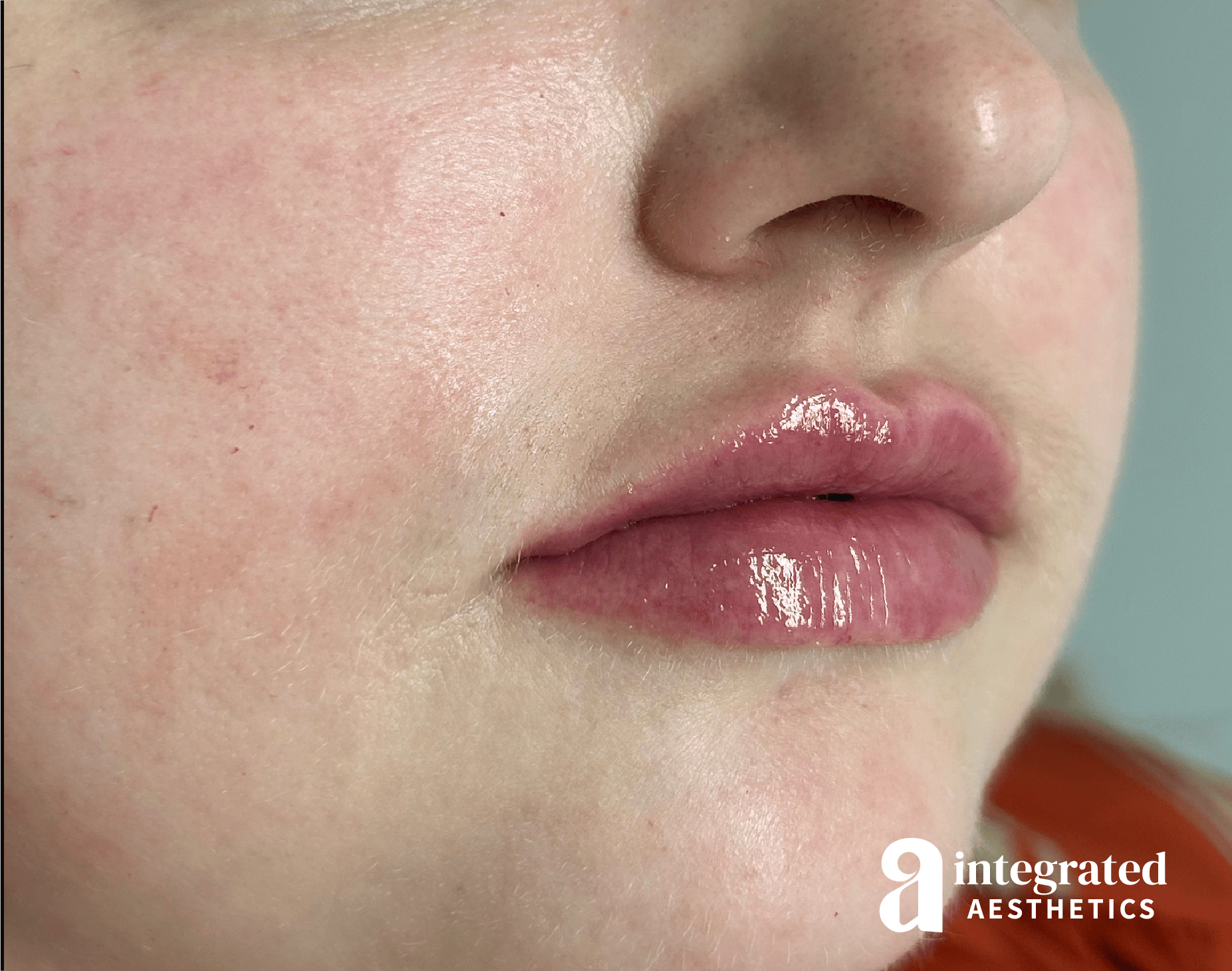 Lip Filler Before & After Gallery - Patient 238479 - Image 4