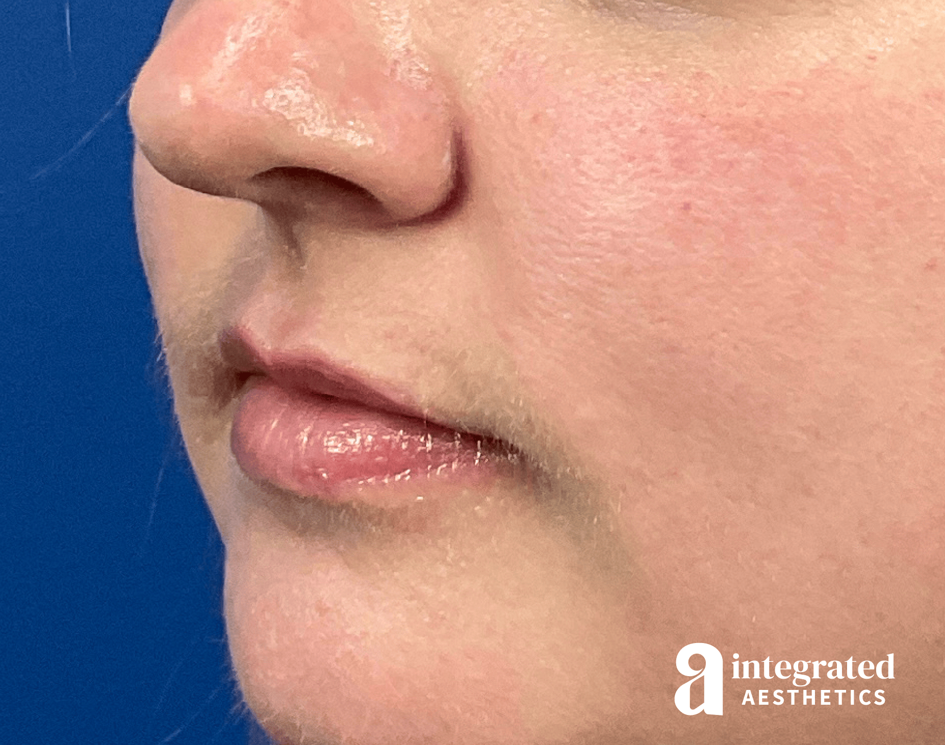 Lip Filler Before & After Gallery - Patient 238479 - Image 5