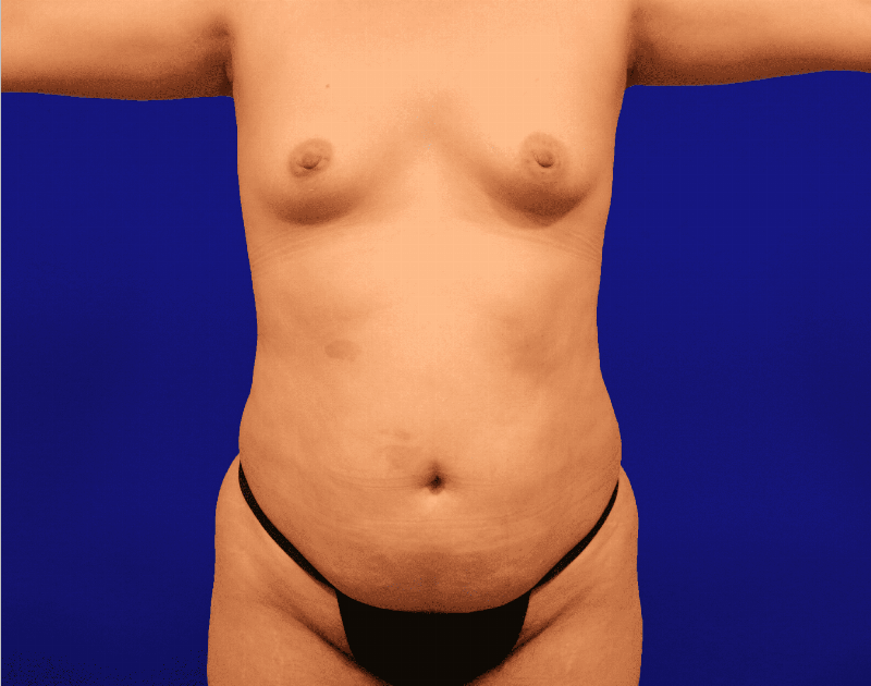 Tummy Tuck Before & After Gallery - Patient 430316 - Image 1