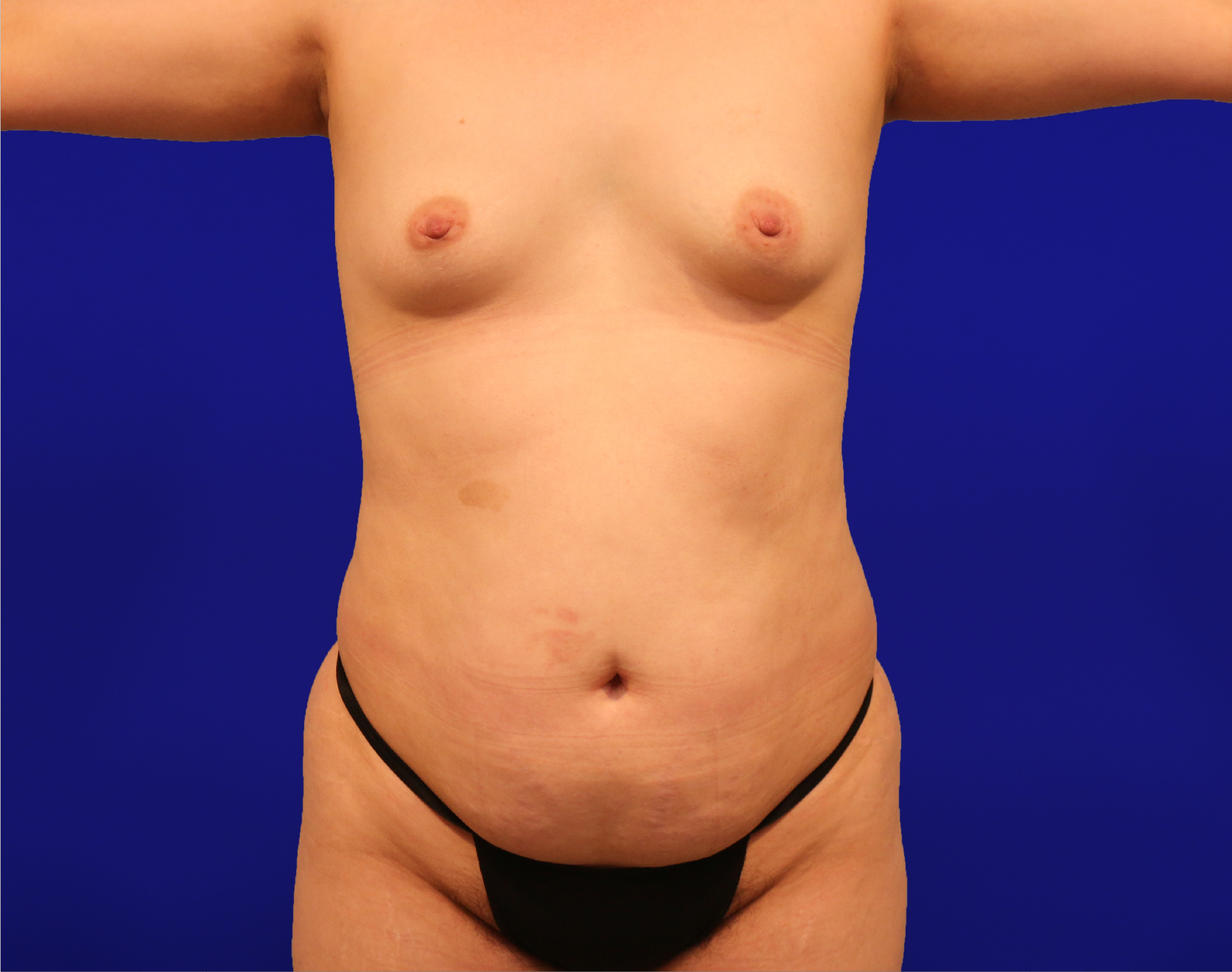 Tummy Tuck Before & After Gallery - Patient 430316 - Image 1