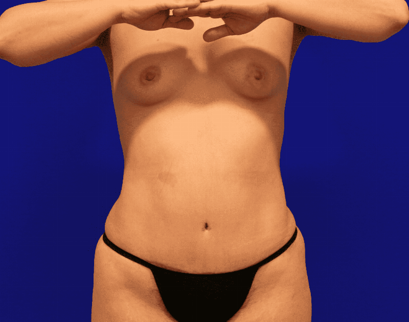 Tummy Tuck Before & After Gallery - Patient 430316 - Image 2