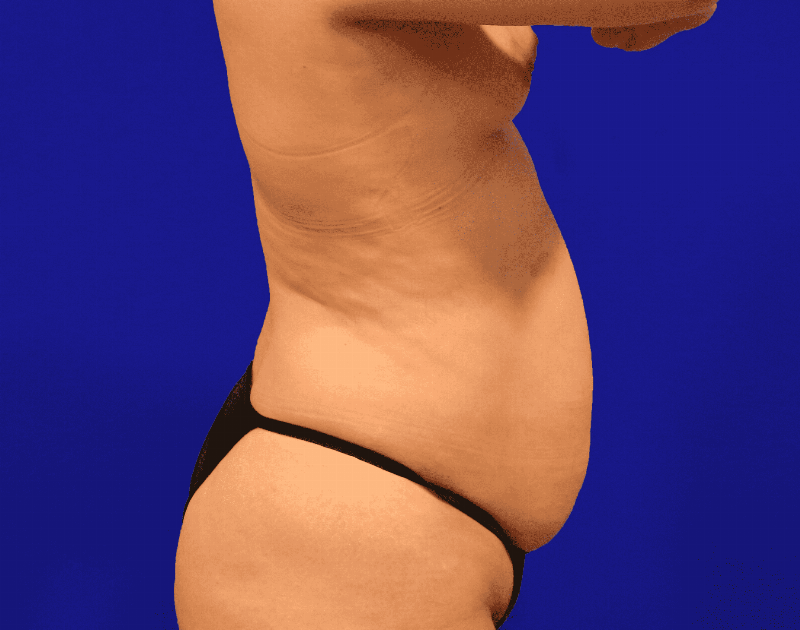 Tummy Tuck Before & After Gallery - Patient 430316 - Image 11