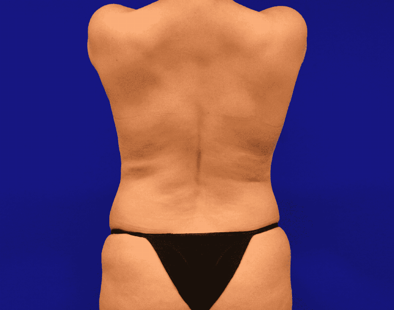 Tummy Tuck Before & After Gallery - Patient 430316 - Image 15