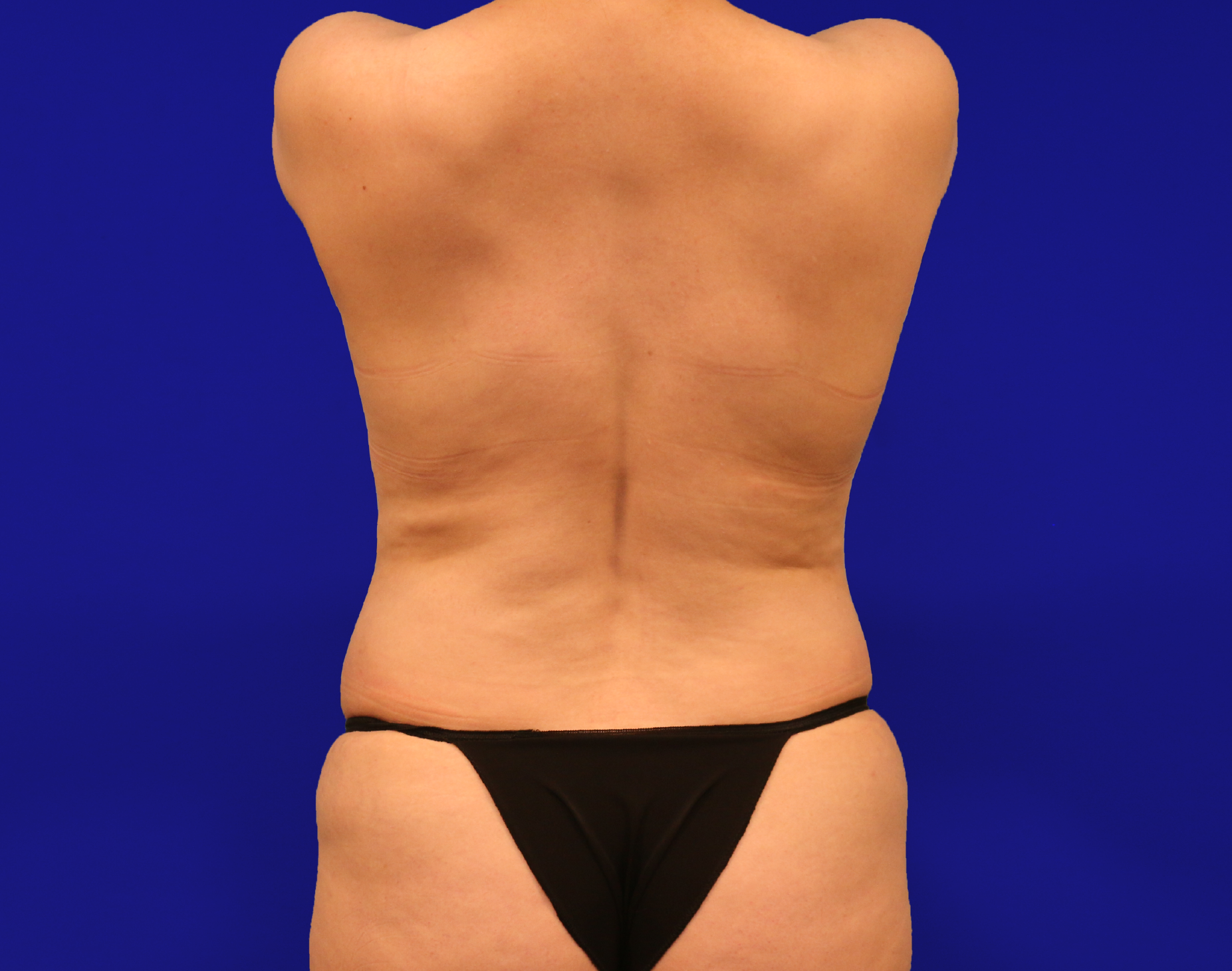 Tummy Tuck Before & After Gallery - Patient 430316 - Image 15