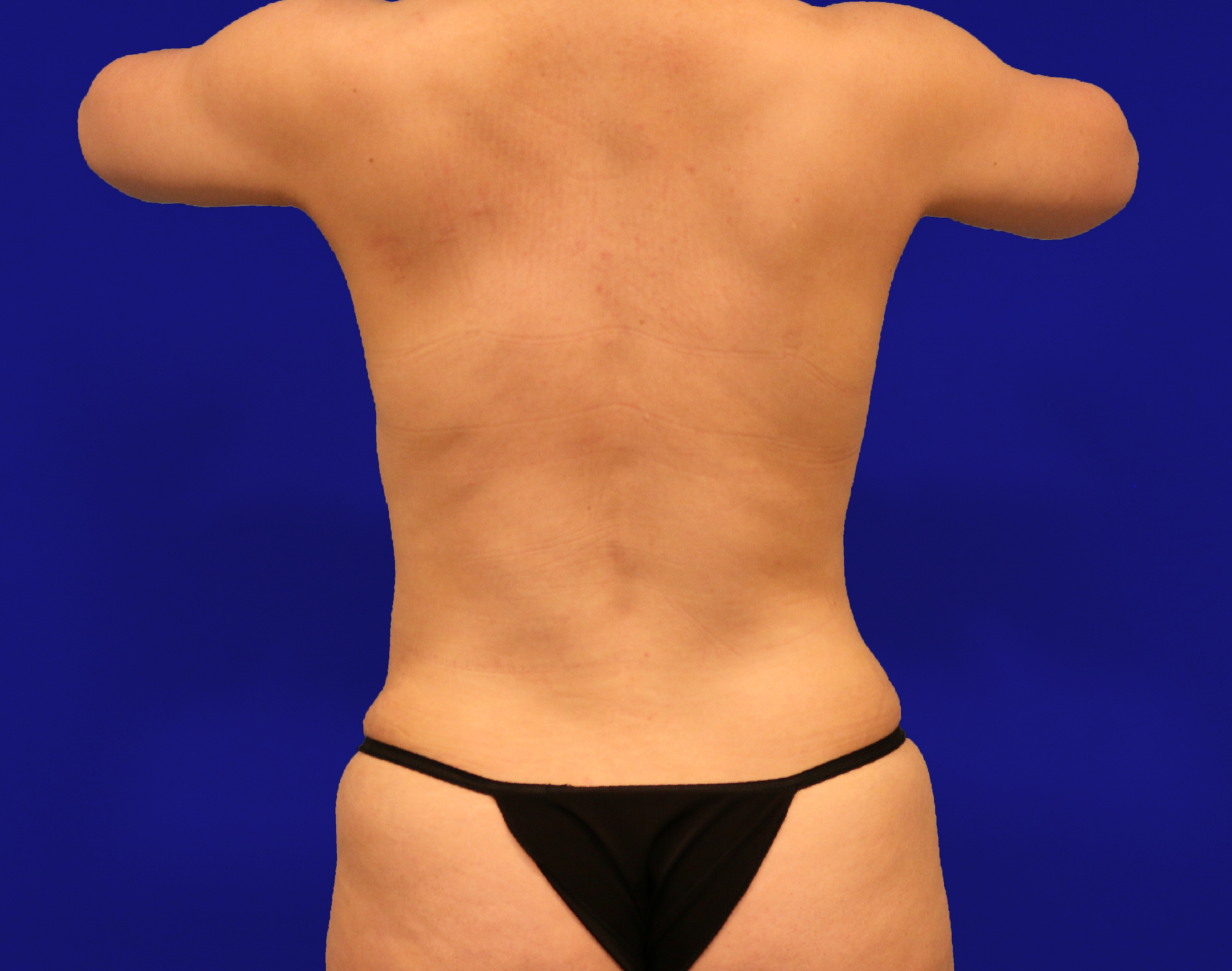 Tummy Tuck Before & After Gallery - Patient 430316 - Image 16