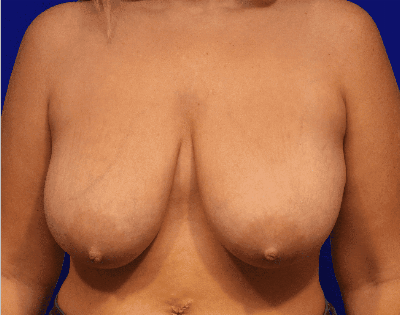 Breast Reduction Before & After Gallery - Patient 719776 - Image 1