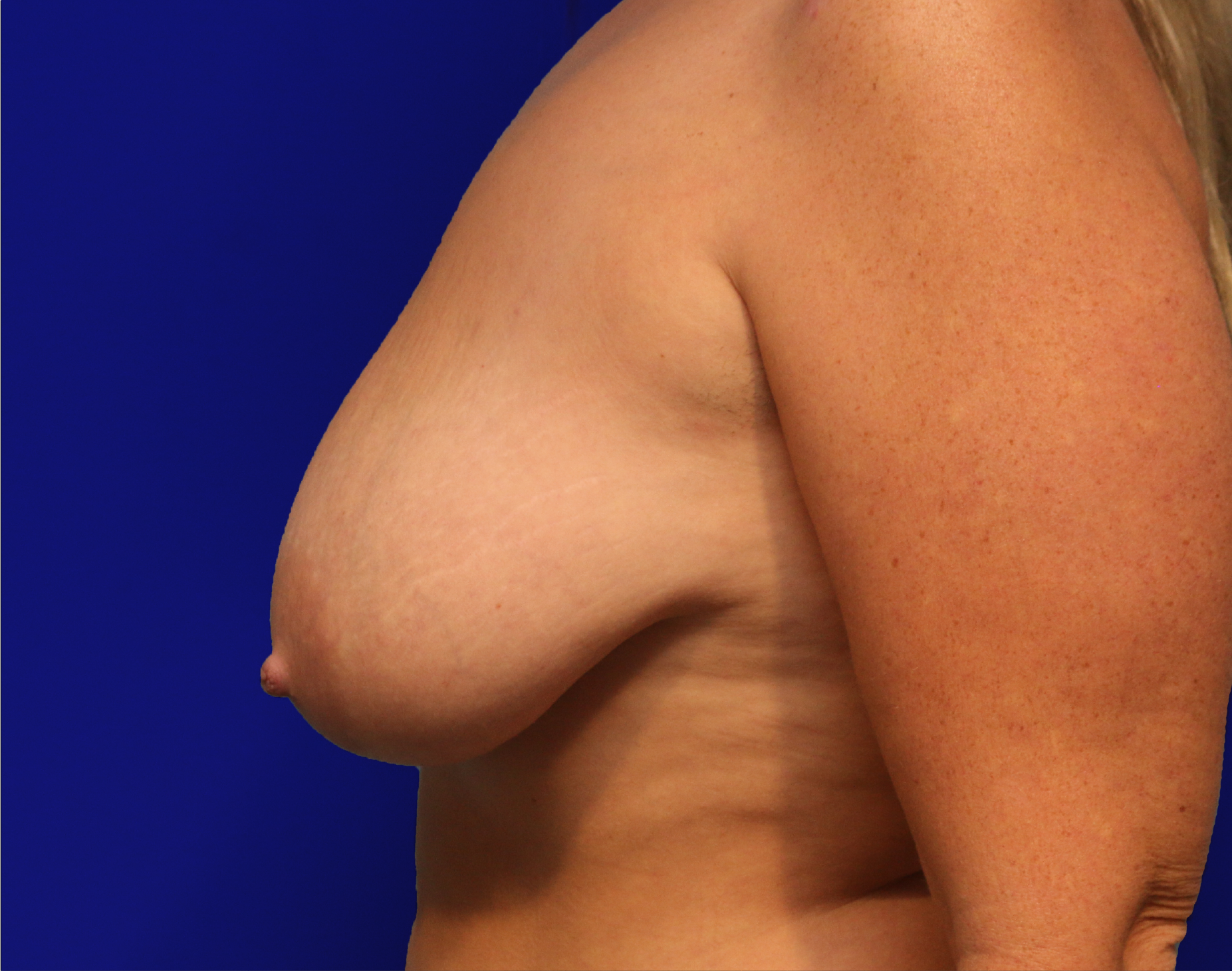 Breast Reduction Before & After Gallery - Patient 719776 - Image 5