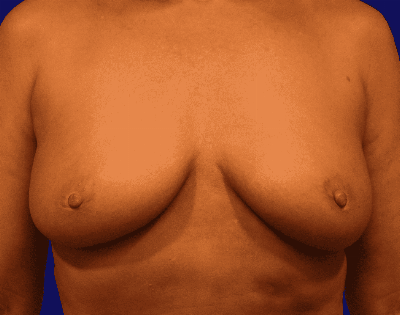 Breast Augmentation Before & After Gallery - Patient 160197 - Image 1