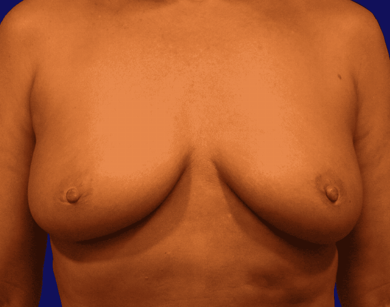 Breast Augmentation Before & After Gallery - Patient 160197 - Image 1