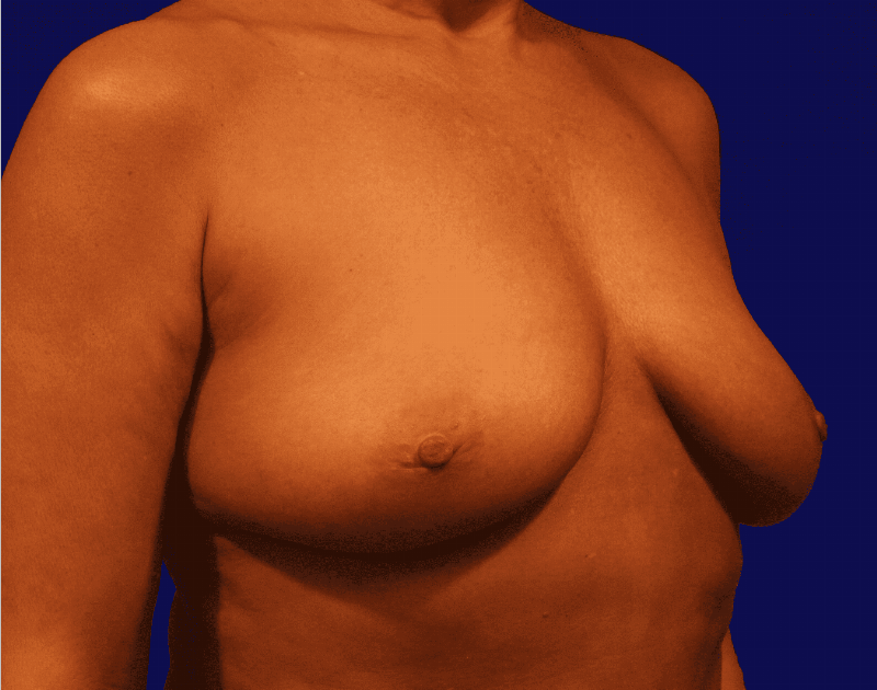 Breast Augmentation Before & After Gallery - Patient 160197 - Image 3