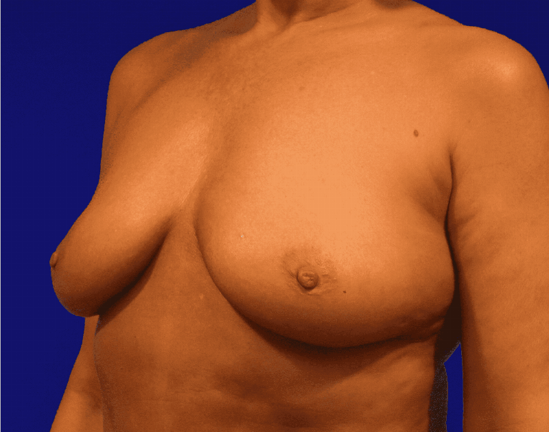 Breast Augmentation Before & After Gallery - Patient 160197 - Image 5